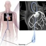 EKG akárcsak