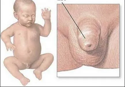 Fitymaszűkületnek a fiúk