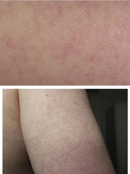 Keratosis pilaris formák és tünetek, kezelések (follikuláris) Keratosis pilaris formák és tünetek, kezelések