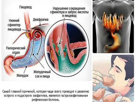 A gastrooesophagealis reflux gyermekek (gyermek grudnichka, újszülött) (gyermek) A gastrooesophagealis reflux gyermekeknél (a gyermek a mell, az újszülött)