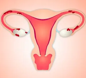 Hormonális endometriózis kezelésének 2