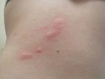 Herpes a testen okainak, a tünetek és a kezelés (herpesz) Herpes a testen okainak, tünetek és a kezelés