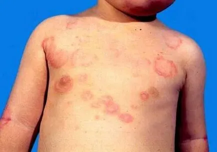 Fertőző erythema gyermekeknél - 30 fotó, tünetei és kezelése, az orvosi oldalon