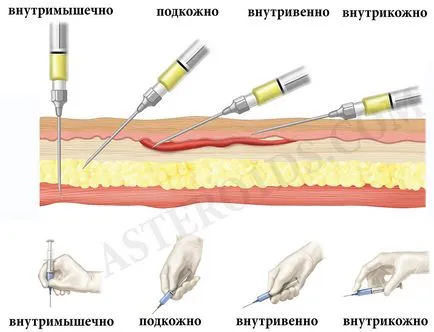 Szteroid injekciók, hogyan kell csinálni injekciót, ha a szúró szteroidok szúró szteroidok (szteroid) Szteroid injekciók, hogyan kell csinálni injekciót, ha a szúró szteroidok, szteroidok, mint a szúró