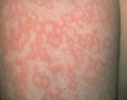 Fertőző erythema gyermekeknél - 30 fotó, tünetei és kezelése, az orvosi oldalon