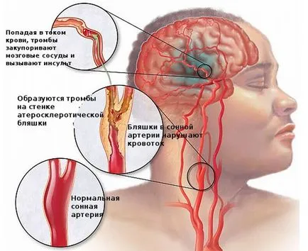 A stroke a jobb mellékhatások élő ischaemiás, vérzéses, jobbkezes (jobbra) A stroke a jobb mellékhatások élő ischaemiás, vérzéses, jobb oldali