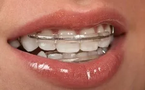 Malocclusion Felnőttek nélkül zárójelek