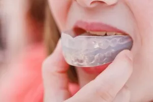 Malocclusion Felnőttek nélkül zárójelek