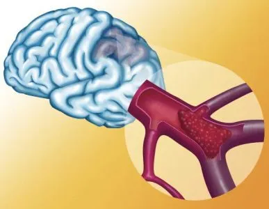 agyi ischaemia, mi ez, tünetek és kezelés hatásának mértéke, hogy mennyire élő (a) agyi ischaemia, mi ez, tünetek és kezelés hatásának mértékét, mennyi az élő