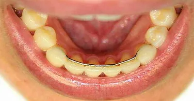 Malocclusion Felnőttek nélkül zárójelek
