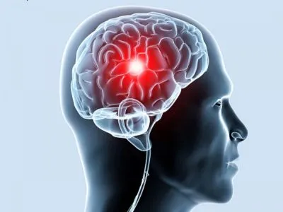 Ischaemia az agyi erek a felnőtt, mi ez a mértéke a tünetek és a betegség kezelésében (agy) Ischaemia az agyi erek a felnőtt, mi ez a mértéke a tünetek és a betegség kezelésében