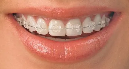 Malocclusion Felnőttek nélkül zárójelek