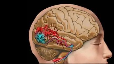agyi ischaemia, mi ez, tünetek és kezelés hatásának mértéke, hogy mennyire élő (kezelés) agyi ischaemia, mi ez, tünetek és kezelés hatásának mértékét, mennyi az élő
