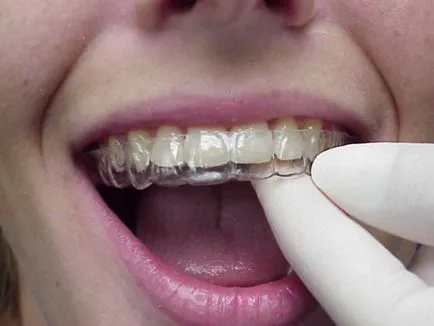 Bite korrekció nélkül nadrágtartó felnőtteknek és gyerekeknek, fotók és egyéb (gyermek) Bite korrekció nélkül nadrágtartó felnőtteknek és gyerekeknek, képek, stb
