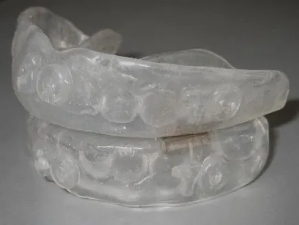 Bite korrekció nélkül nadrágtartó felnőtteknek és gyerekeknek, fotók, stb (korrekció) Bite korrekció nélkül nadrágtartó felnőtteknek és gyerekeknek, képek, stb