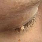 Hogyan kell kezelni a szemhéj papilloma (papilloma) Hogyan kell kezelni a szemhéj papilloma