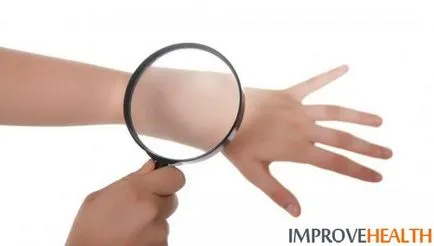 Hogyan kell kezelni a szemhéj papilloma (papilloma) Hogyan kell kezelni a szemhéj papilloma