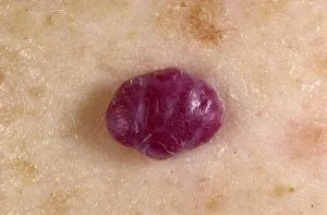 Hogyan kell kezelni, és távolítsa el a lézeres hemangióma, propranolol, timolol gél, arutimolom, anaprilinom (lézeres kezelés haemangiomáknak) Hogyan kell kezelni, és távolítsa el a lézeres hemangióma, propranolol, timolol gél, arutimolom, anaprilinom