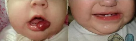 Hogyan kell kezelni, és távolítsa el a lézeres hemangióma, propranolol, timolol gél, arutimolom, anaprilinom (hemangioma lézeres eltávolítása alapján) Hogyan kell kezelni, és távolítsa el a lézeres hemangióma, propranolol, timolol gél, arutimolom, anaprilinom