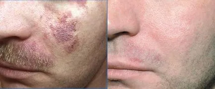 Hogyan kell kezelni, és távolítsa el a lézeres hemangioma, propranolol, timolol gél, arutimolom, anaprilinom (moxibustion hemangioma nitrogén) Hogyan kell kezelni, és távolítsa el a lézeres hemangióma, propranolol, timolol gél, arutimolom, anaprilinom