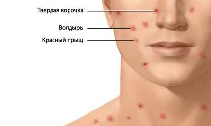 Mivel az első jelei a bárányhimlő kezdődik (kezdődik) Mivel az első jelei a bárányhimlő kezdődik