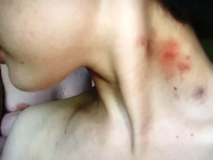 Hogyan tegye Hickey
