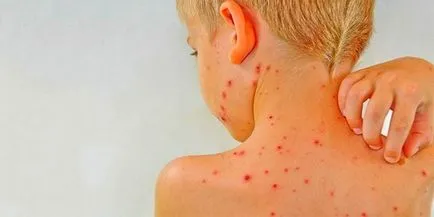 Hogyan működik a bőrallergia, piros foltok és kezelésük (foltok) Hogyan működik a bőrallergia, piros foltok és kezelésük