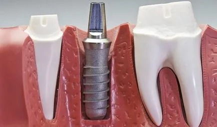 A fogászati ​​implantátumok faj, ami jobb, sokan