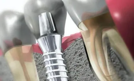 A fogászati ​​implantátumok faj, ami jobb, sokan