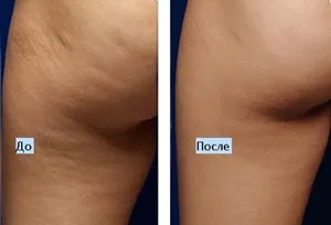 Ami a héten, hogy megszabaduljon a cellulit - Lépésről lépésre küzdelem (harc) Ami a héten, hogy megszabaduljon a cellulit - Lépésről lépésre harc