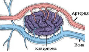 agy kavernoma (barlangos anglöma és hemangioma), mi ez, a következmények kezelésére (az agy) agy kavernoma (barlangos anglöma és hemangioma), mi az, következményeinek kezelésére