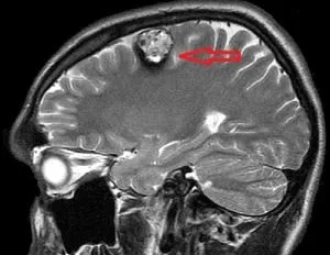 agy kavernoma (barlangos anglöma és hemangioma), mi ez, a következmények kezelésére (agyi kavernoma következmények) agy kavernoma (barlangos anglöma és hemangioma), mi az, következményeinek kezelésére