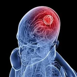agy kavernoma (barlangos anglöma és hemangioma), mi ez, a következmények kezelésére (barlangos hemangioma az agy) agy kavernoma (barlangos anglöma és hemangioma), mi az, következményeinek kezelésére