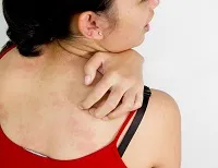 Contact dermatitis kezelésére és népi jogorvoslati kenőcsök (kenőcsök) Contact dermatitis kezelésére kenőcsöket és népi jogorvoslati