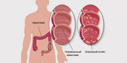 Colitis, bélrendszeri tünetek és felnőttek kezelésére népi jogorvoslat