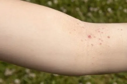 Molluscum contagiosum kezelt gyermekeknél otthon, az eltávolítása (otthon) Molluscum contagiosum kezelt gyermekeknél otthon, megszüntetve