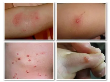 Molluscum contagiosum - eltávolítás Budapest (szilárd rózsaszín) Molluscum contagiosum - eltávolítása a Budapesti