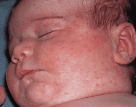 Kontakt dermatitis - Kezelés, tünetei, okai