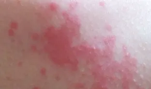 Vörös foltok a testen a fotó, az okokat és a lehetséges betegség, növedékek a bőrön