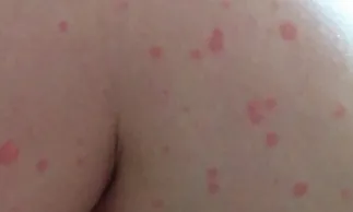 Vörös foltok a testen a fotó, az okokat és a lehetséges betegség, növedékek a bőrön