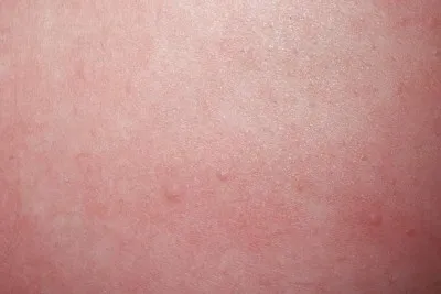 Vörös foltok a testen viszket, viszket, amelyek megjelennek, mint egy élvezet (a test) Vörös foltok a testen viszket, viszket, amelyek megjelennek, mint egy élvezet