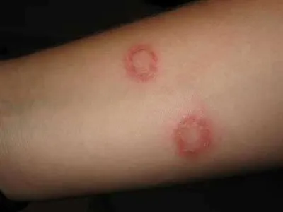 Vörös foltok a testen viszket, viszket, amelyek megjelennek, mint egy élvezet (foltok) Vörös foltok a testen viszket, viszket, amelyek megjelennek, mint egy élvezet