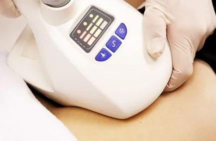 Cryolipolysis - mi az eljárás előtt és után, az ajánlások