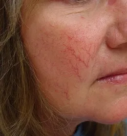 Rosacea az arc