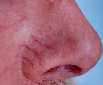 Rosacea az arc