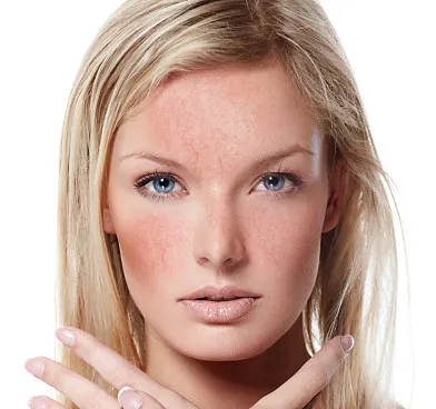 Rosacea mi ez, kezelés - article - pda verzió