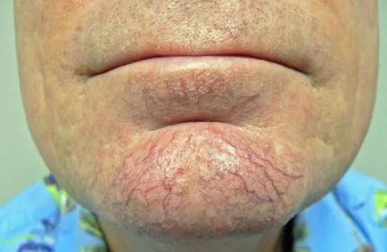 Rosacea az arc