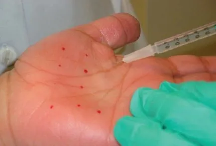 Kezelése túlzott izzadás a kezében jelenlegi terápiák, nincs izzadás (hiperhidrózis) Kezelése túlzott izzadás a kezében jelenlegi terápiák, nincs izzadás