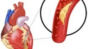 Microinfarction - tünetei speciális kezelésnek (minor stroke) Microinfarction - tünetek korai jelei és jellemzői kezelés