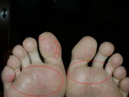Többféle módon foglalkozik a jelenség a dudorok a lábujjak (duzzanatok) Többféle módon foglalkozik a jelenség a dudorok a lábujjak